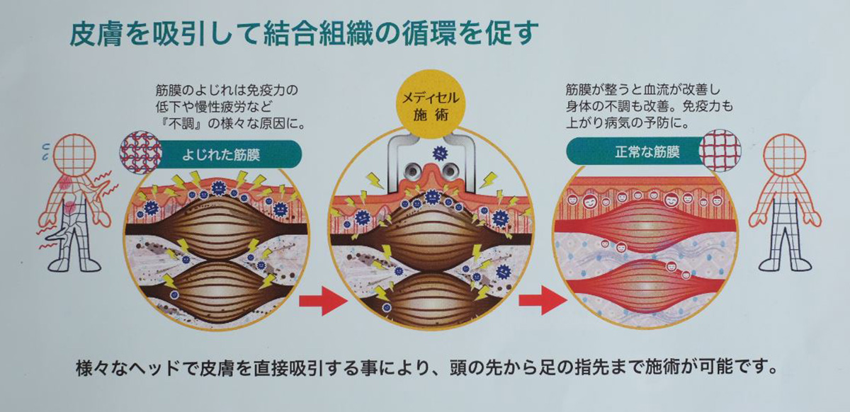 筋膜リリース施術を行っています